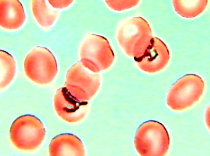 Babesia in red blood cells