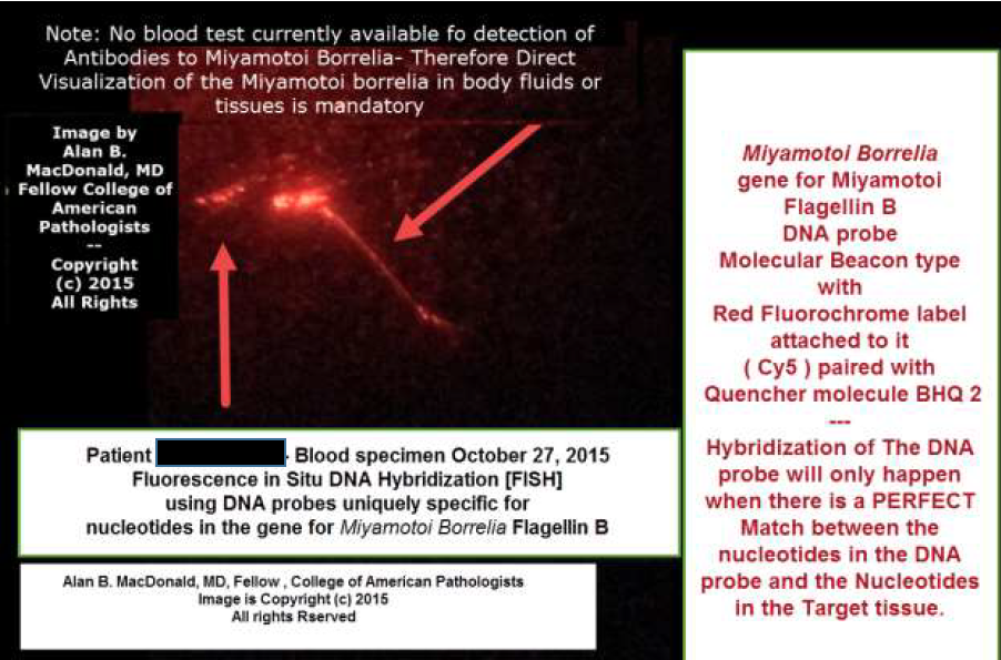 First Human Case Of Borrelia Miyamotoi In Norway NorVect